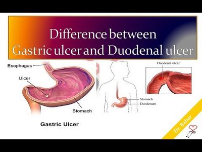 What Is A Peptic Ulcer?