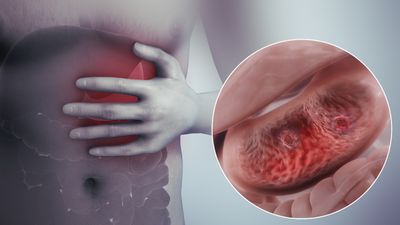 What Is A Peptic Ulcer?
