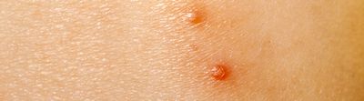 What You Need To Know About Molluscum Contagiosum