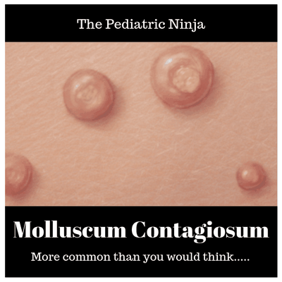 What You Need To Know About Molluscum Contagiosum